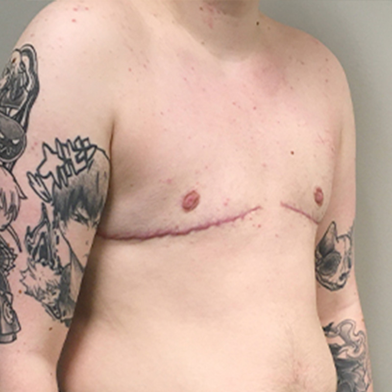 Female To Male Top Surgery 03
