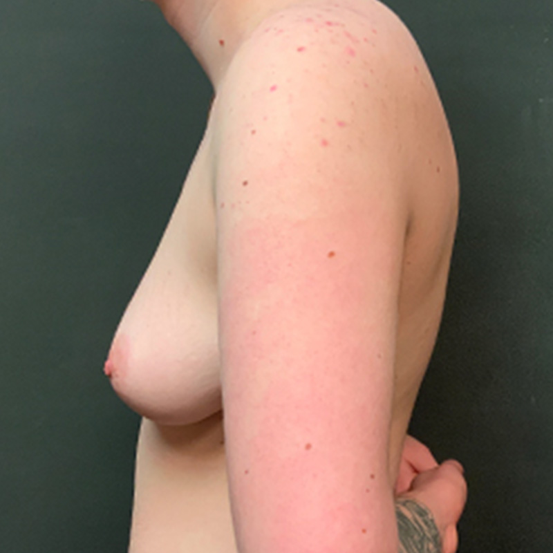 Female To Male Top Surgery 09