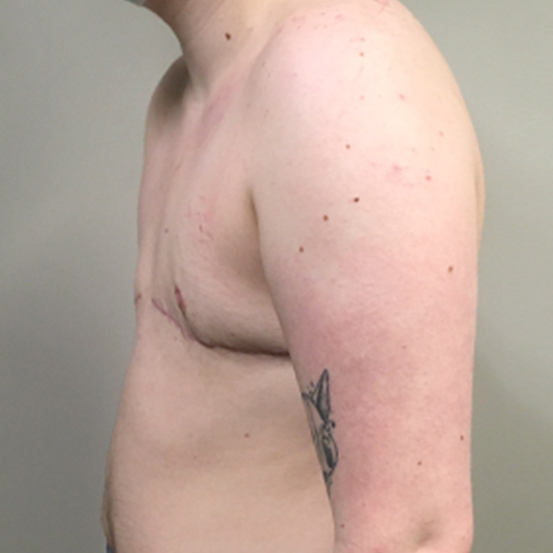 Female To Male Top Surgery 09