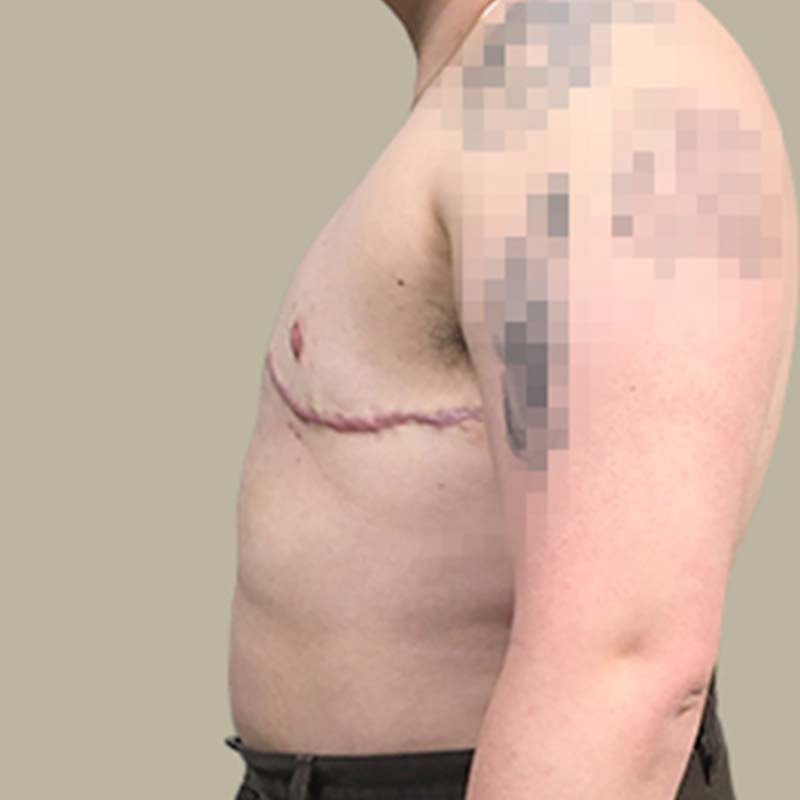 Female To Male Top Surgery 03