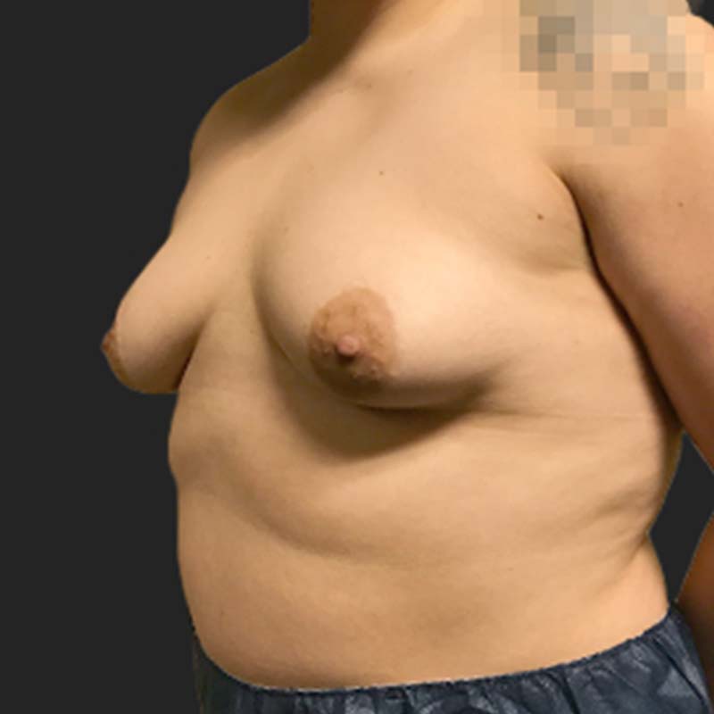 Female To Male Top Surgery 05