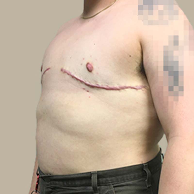 Female To Male Top Surgery 05