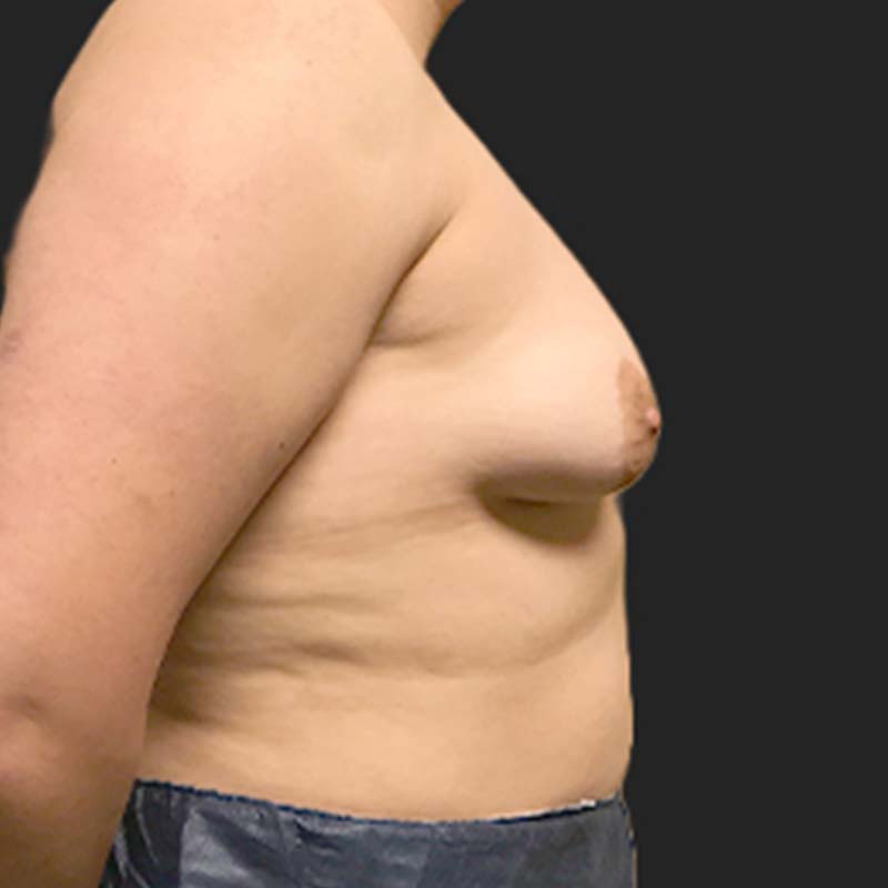 Female To Male Top Surgery 07