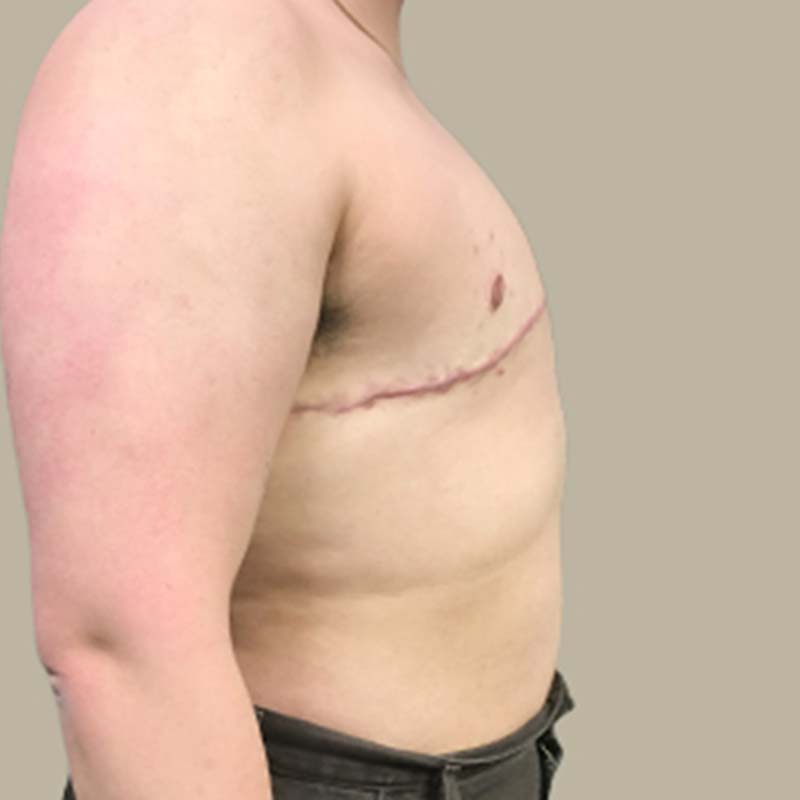 Female To Male Top Surgery 07