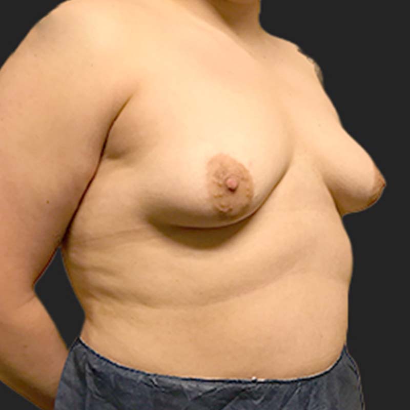 Female To Male Top Surgery 09