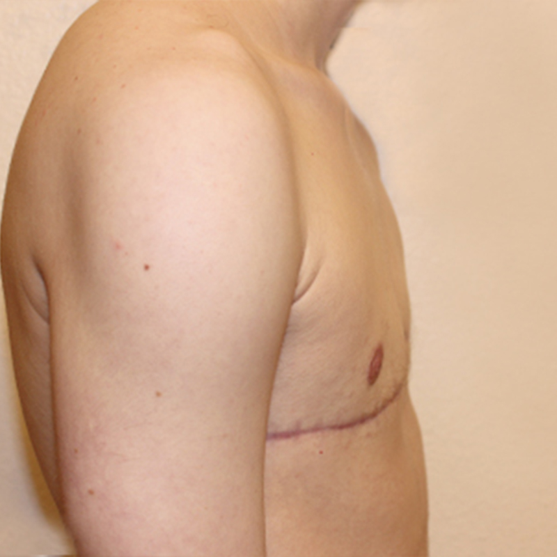 Female To Male Top Surgery 09