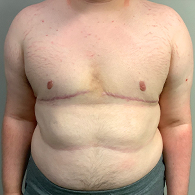 Female To Male Top Surgery 27