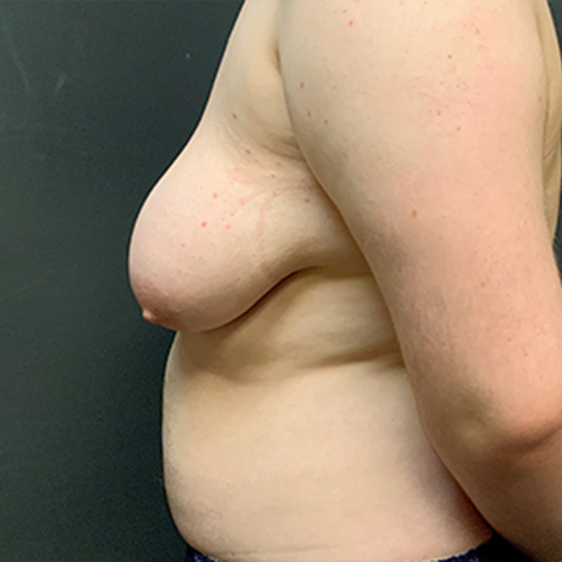 Female To Male Top Surgery 05