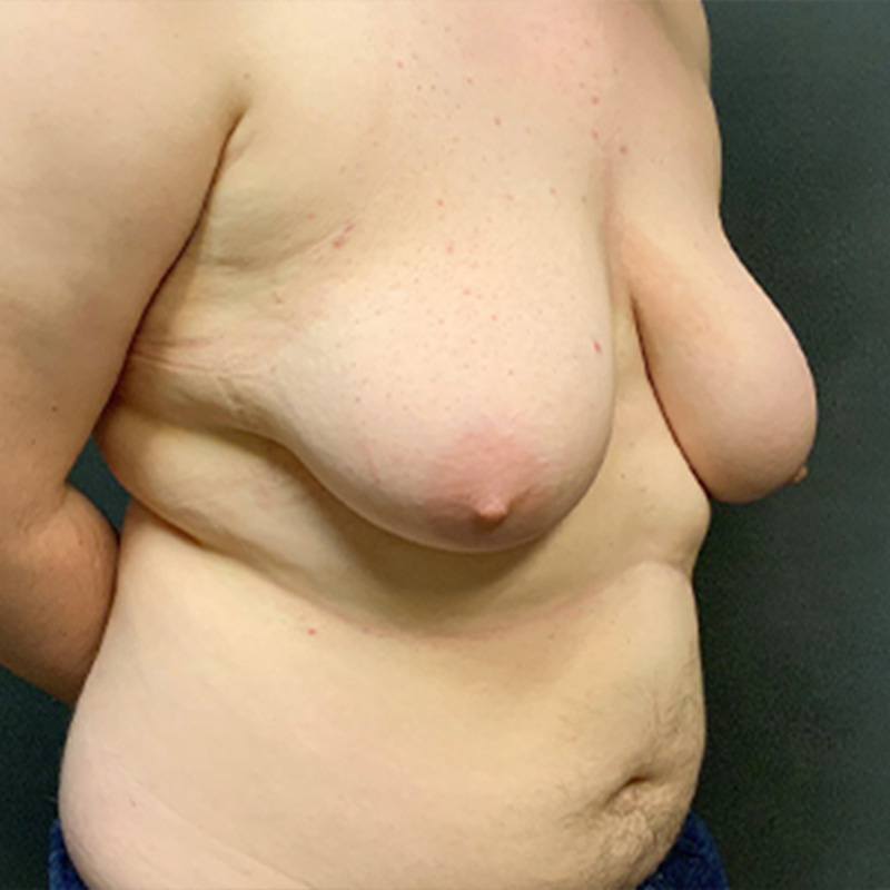 Female To Male Top Surgery 07