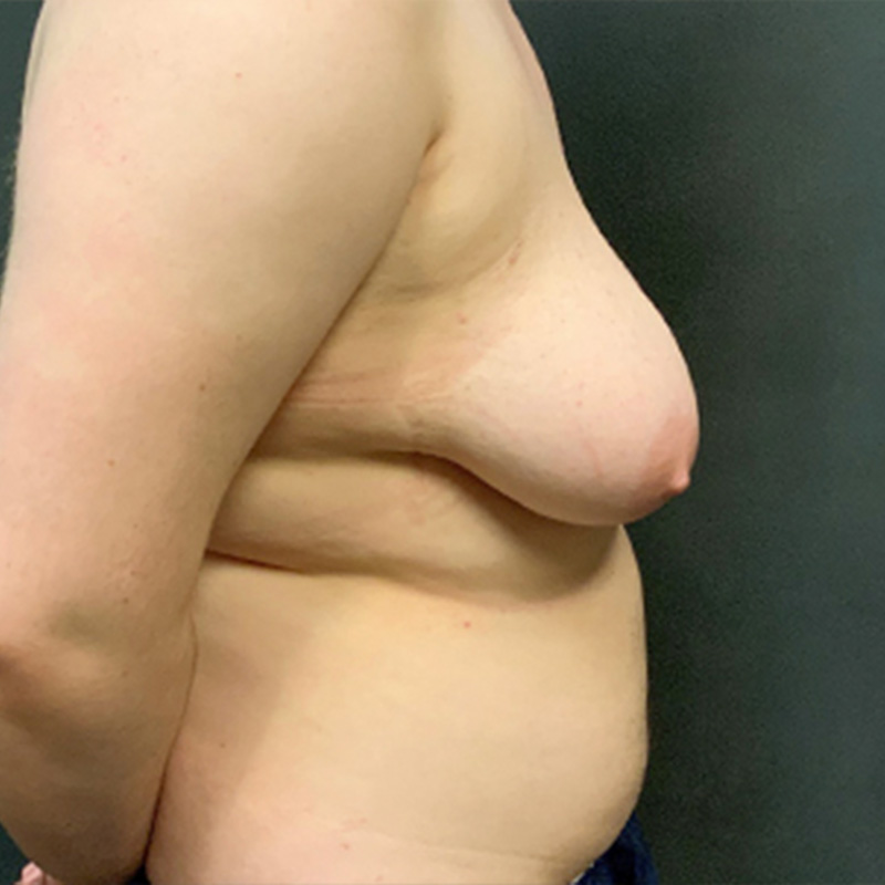 Female To Male Top Surgery 09