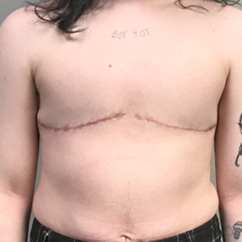 Female To Male Top Surgery 28