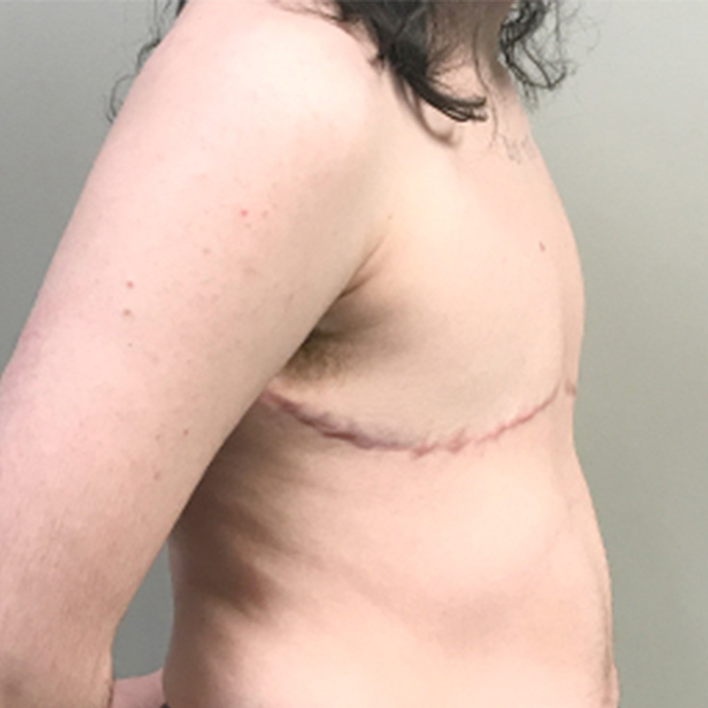 Female To Male Top Surgery 03