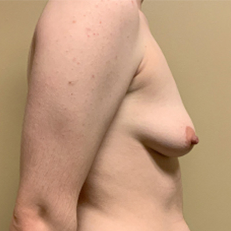 Female To Male Top Surgery 05