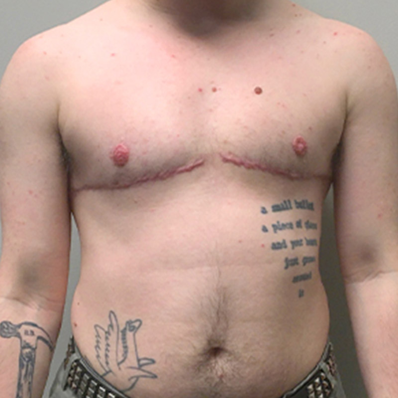 Female To Male Top Surgery 29