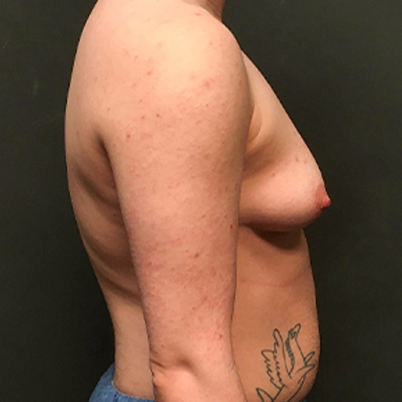 Female To Male Top Surgery 07