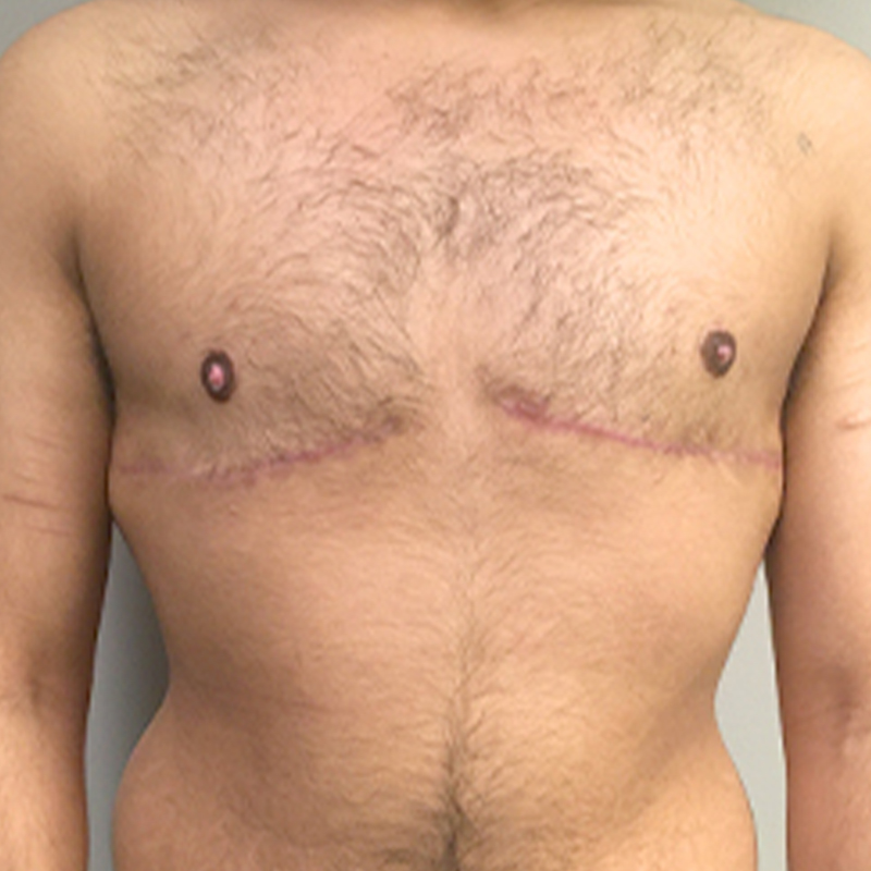 Female To Male Top Surgery 30