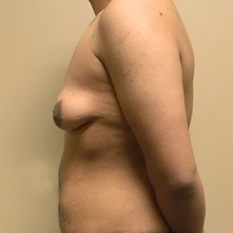 Female To Male Top Surgery 05