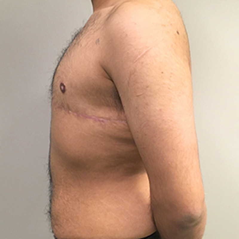 Female To Male Top Surgery 05