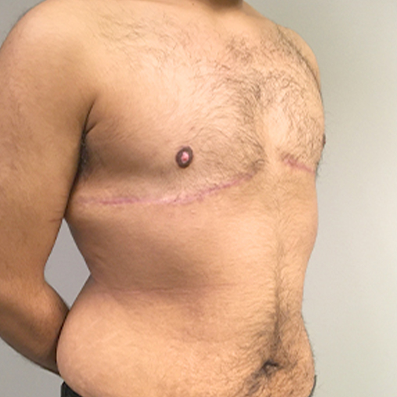 Female To Male Top Surgery 07