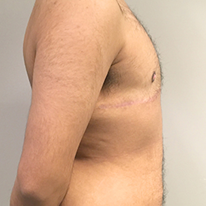 Female To Male Top Surgery 09