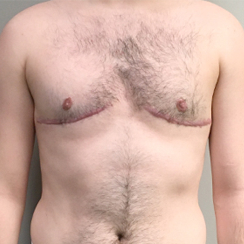 Female To Male Top Surgery 31