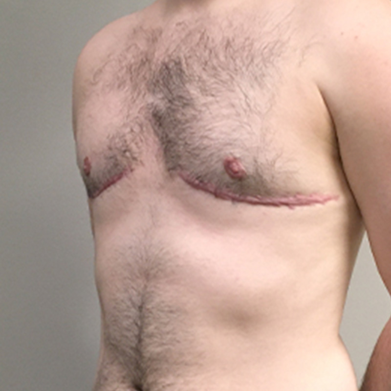 Female To Male Top Surgery 03