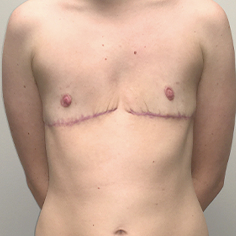 Female To Male Top Surgery 32