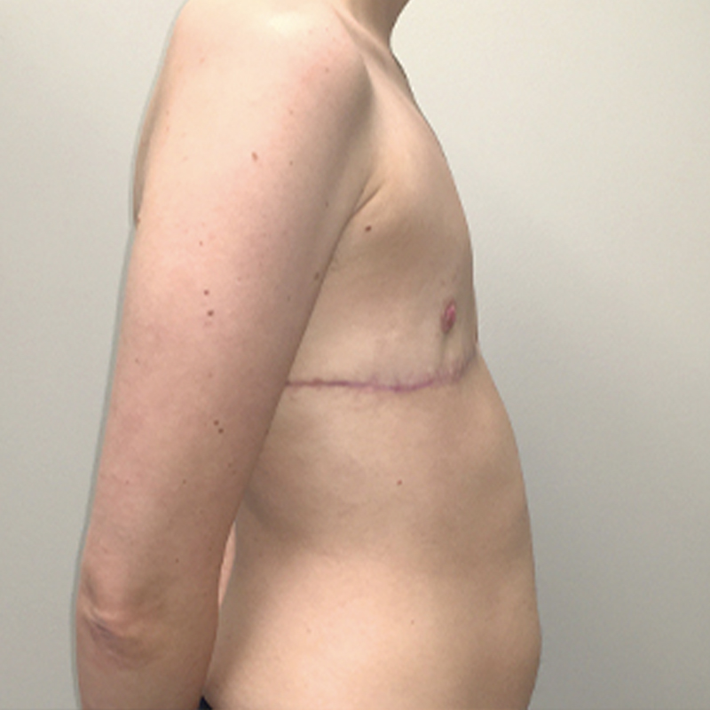 Female To Male Top Surgery 05