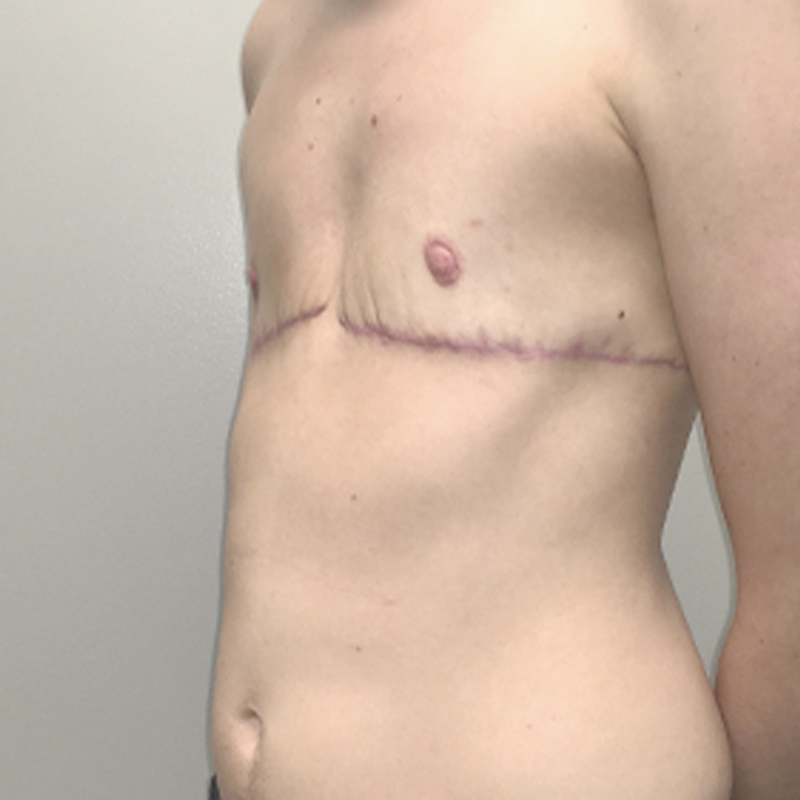 Female To Male Top Surgery 07