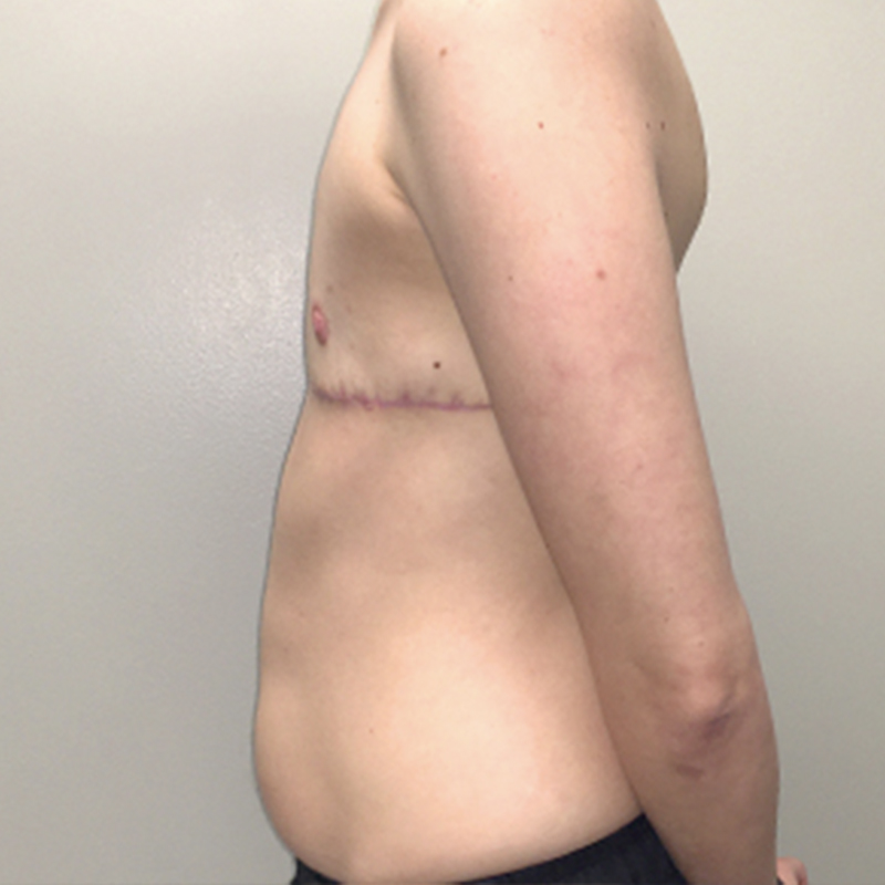 Female To Male Top Surgery 09