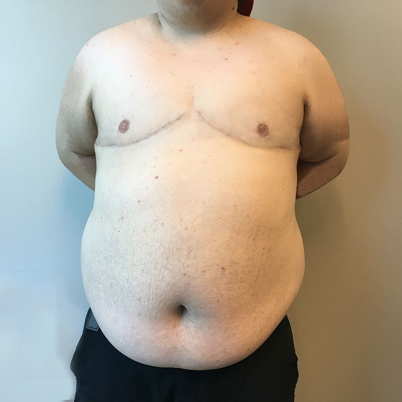 Female To Male Top Surgery 33