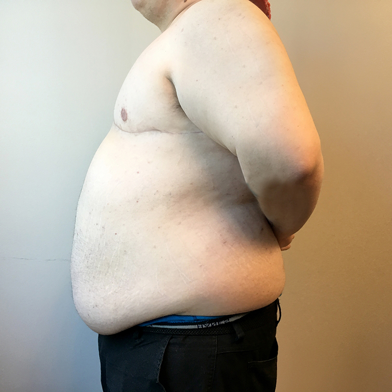 Female To Male Top Surgery 03