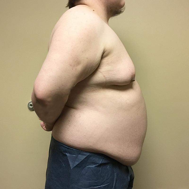 Female To Male Top Surgery 05