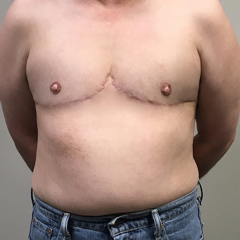 Female To Male Top Surgery 34