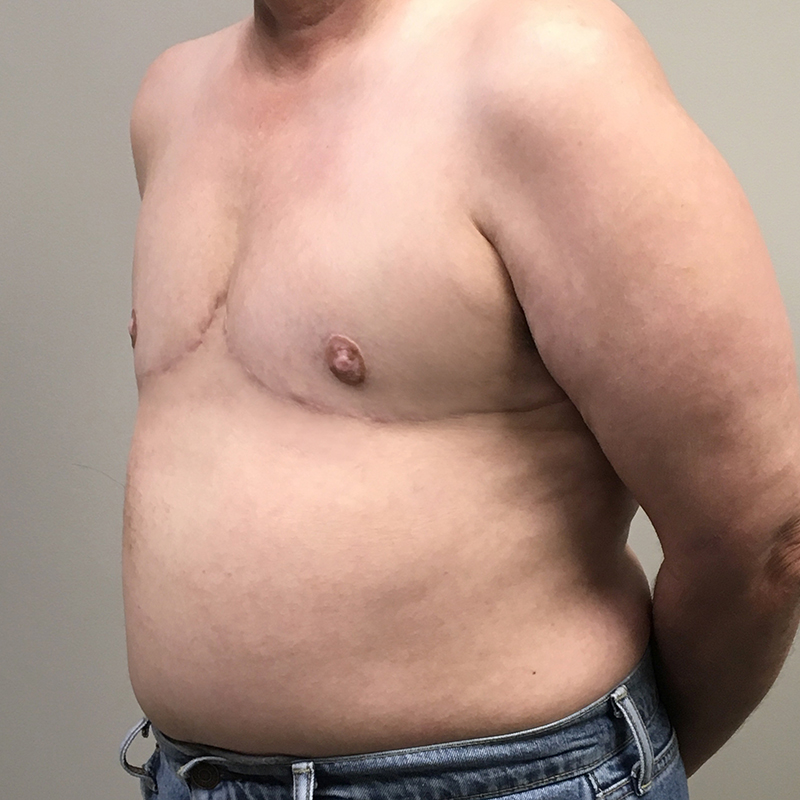 Female To Male Top Surgery 03