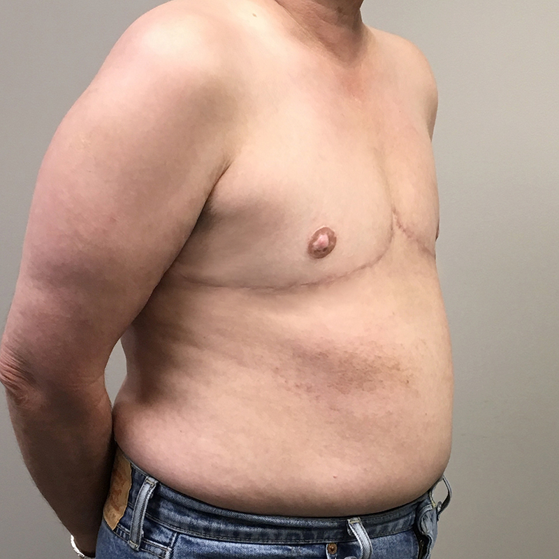 Female To Male Top Surgery 05