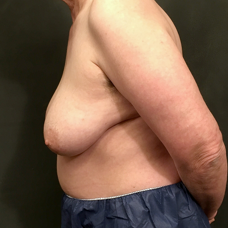 Female To Male Top Surgery 07