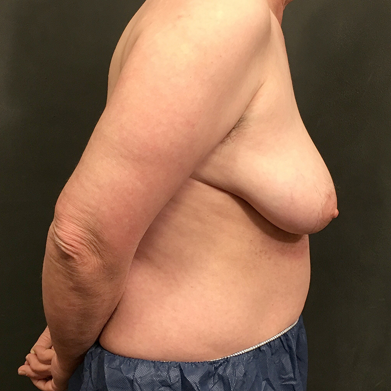 Female To Male Top Surgery 09