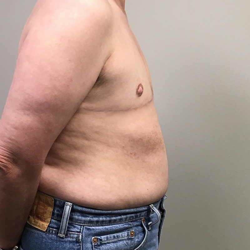 Female To Male Top Surgery 09