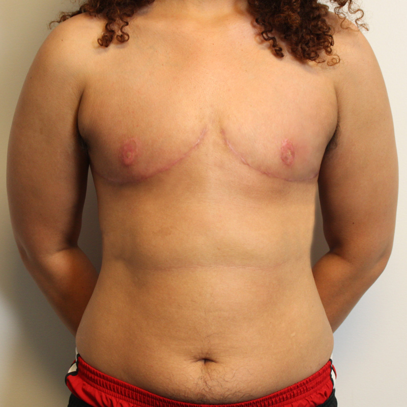 Female To Male Top Surgery 35