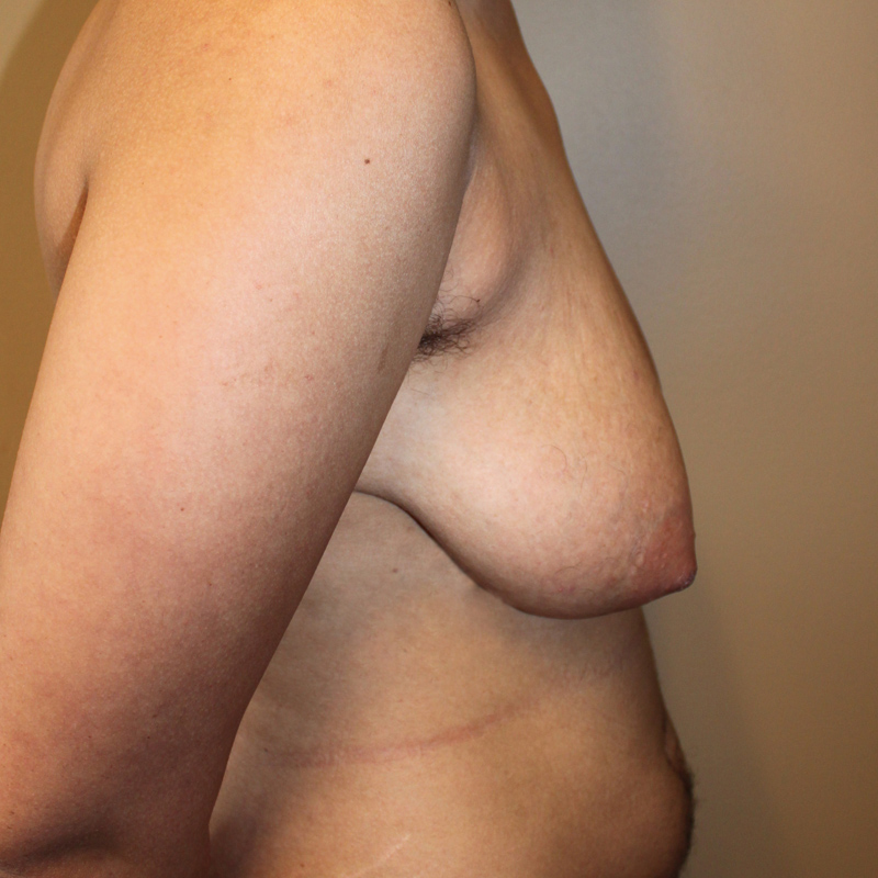 Female To Male Top Surgery 09