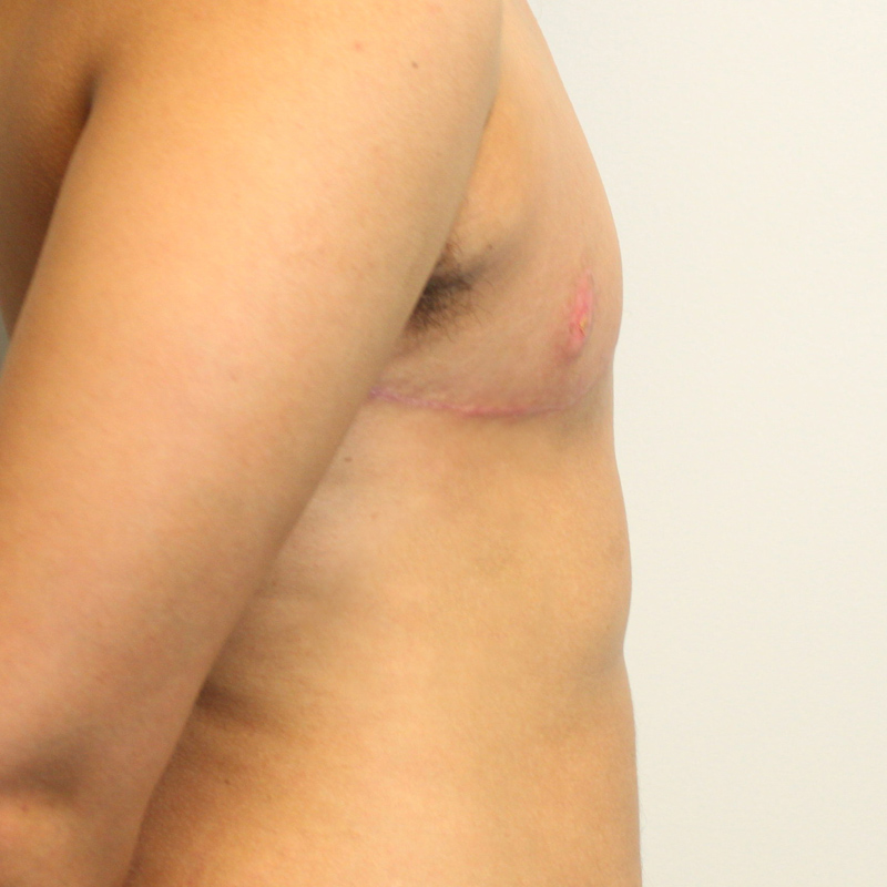 Female To Male Top Surgery 09