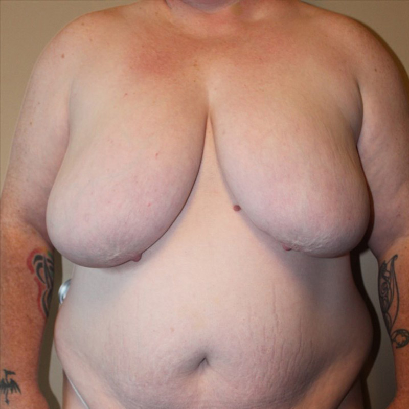 Female To Male Top Surgery 01