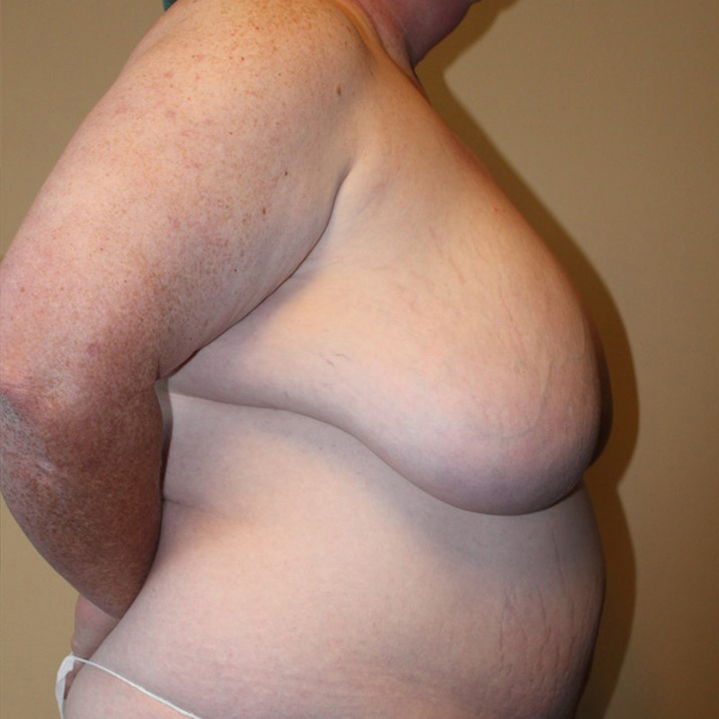 Female To Male Top Surgery 05