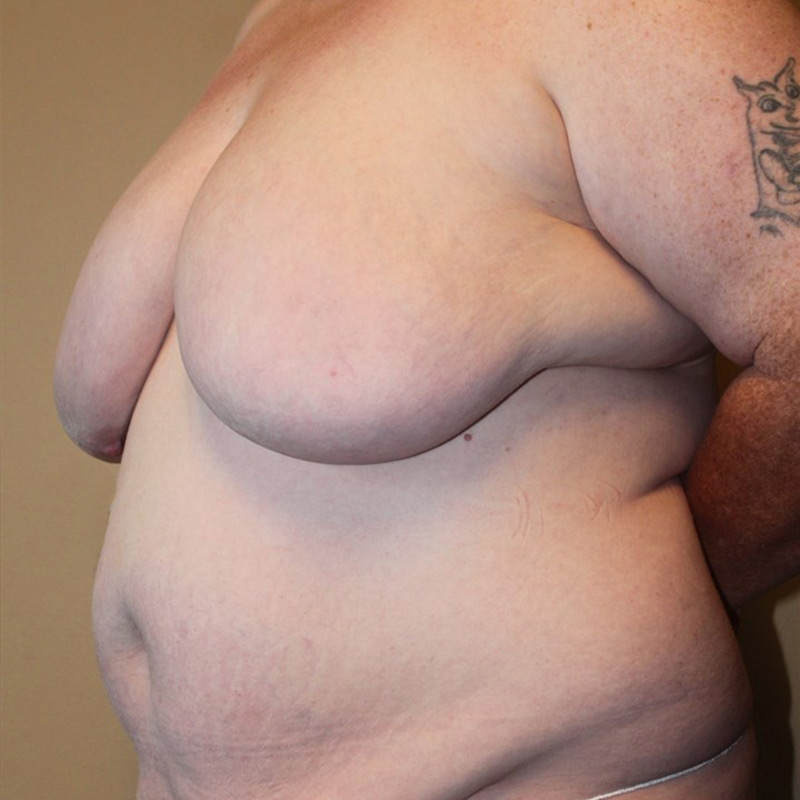 Female To Male Top Surgery 07