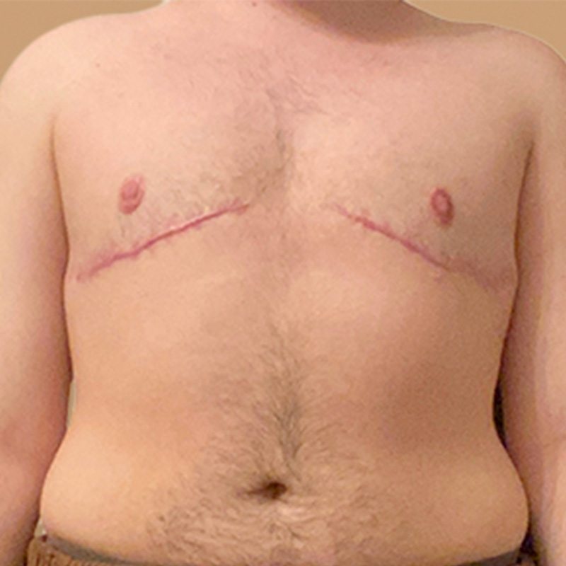 Female To Male Top Surgery 37