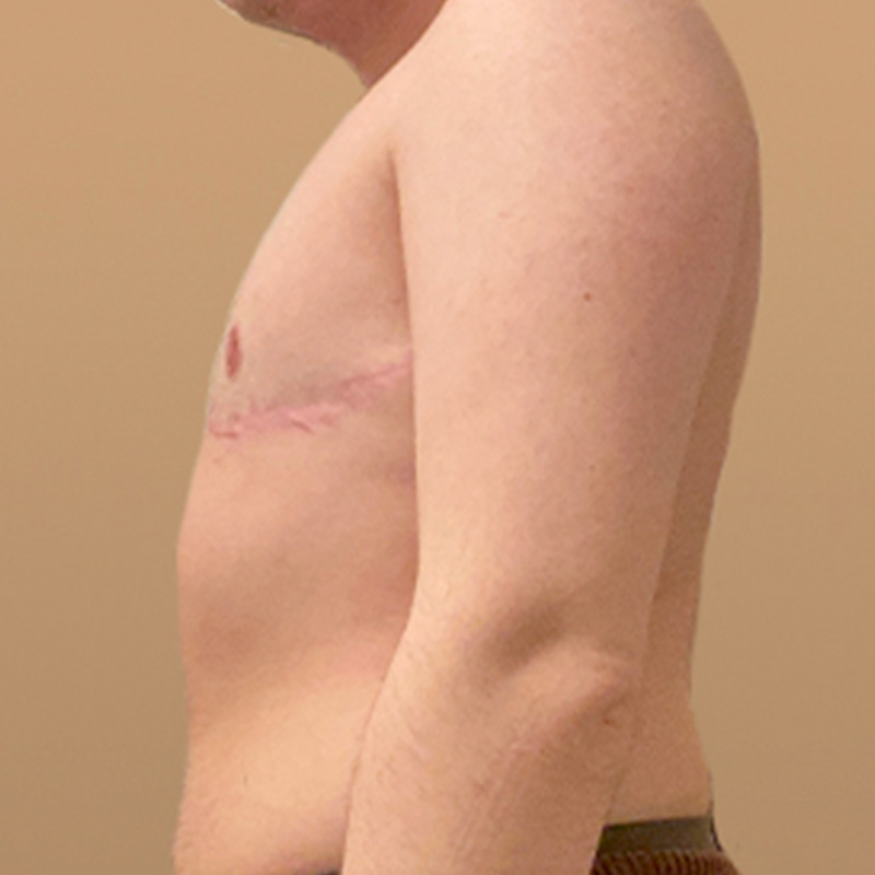 Female To Male Top Surgery 05