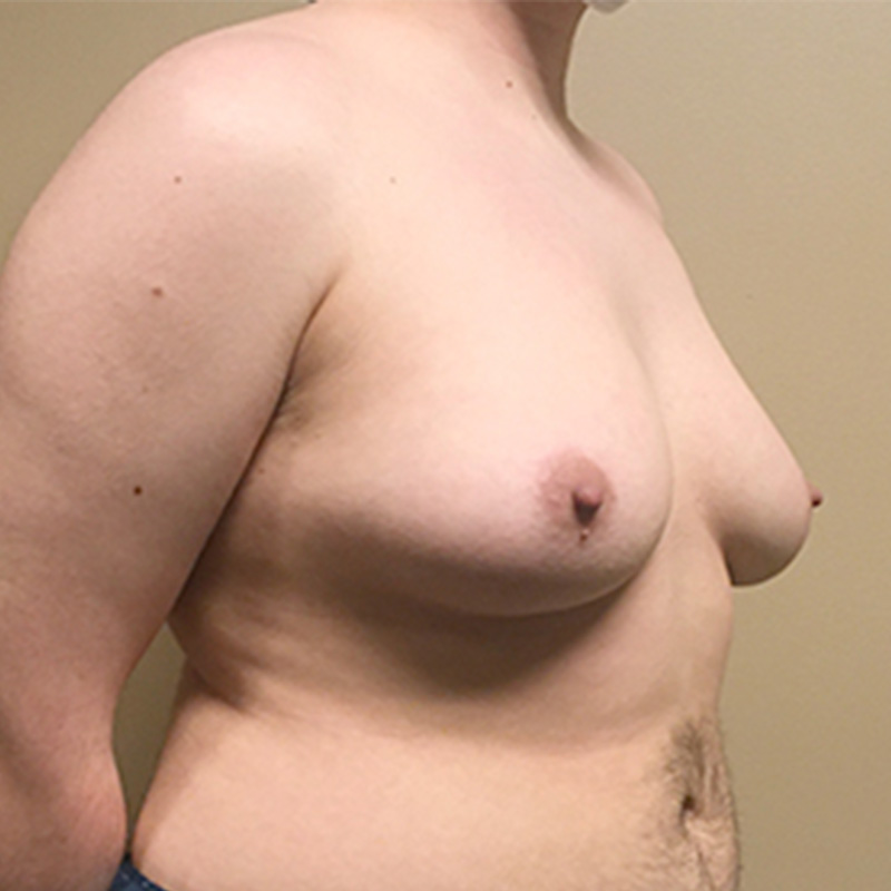 Female To Male Top Surgery 07