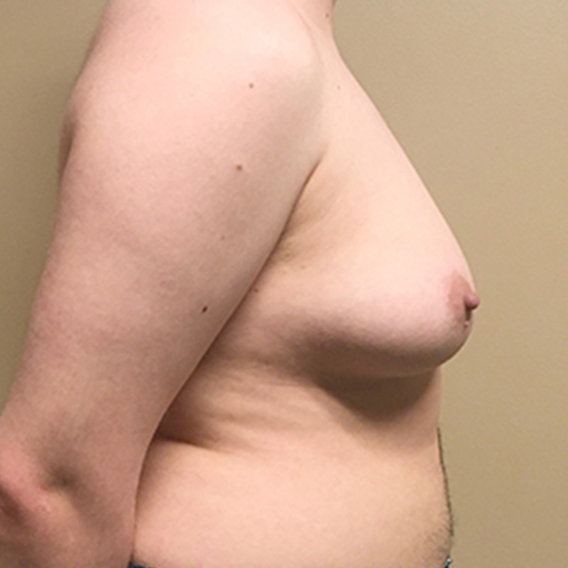 Female To Male Top Surgery 09