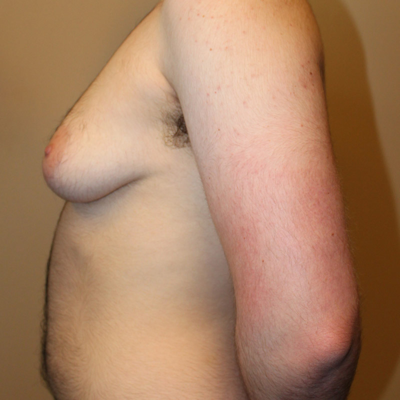 Female To Male Top Surgery 07